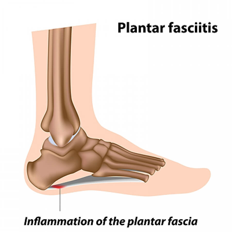 Inflammation of the best sale plantar fascia